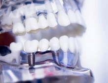 Самая важная информация о зубных имплантатах